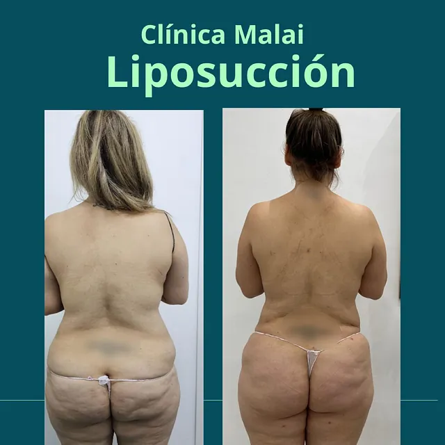 Clínica Malai antes y despues