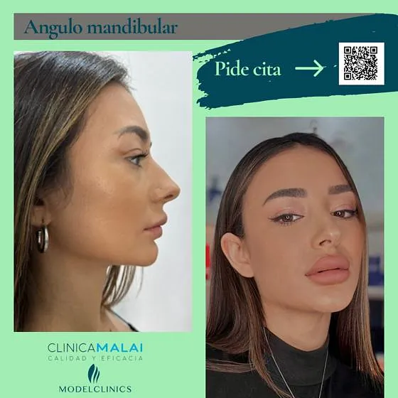 Clínica Malai antes y despues