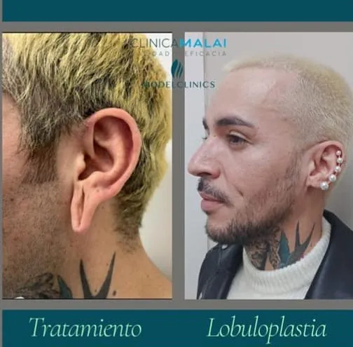 Clínica Malai antes y despues