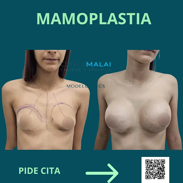 Clínica Malai antes y despues