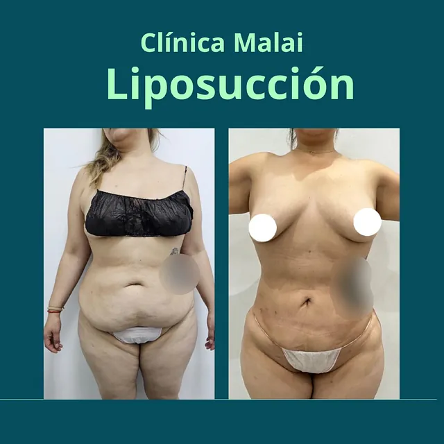 Clínica Malai antes y despues