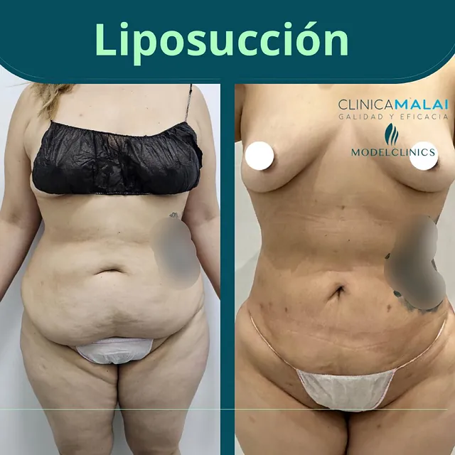 Clínica Malai antes y despues